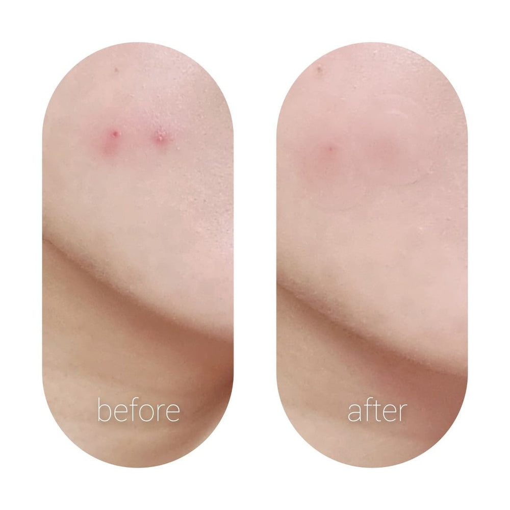 Original Blemish Spot Care & Cover Patch