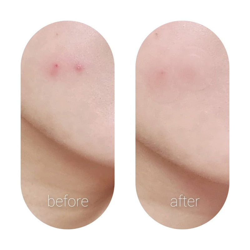 Original Blemish Spot Care & Cover Patch